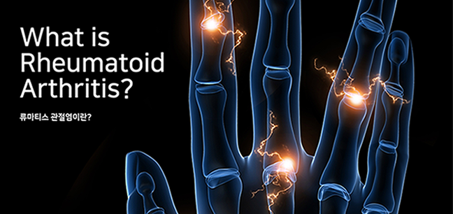 what is pheumatoid arthritis? 류마티스 관절렴이란?